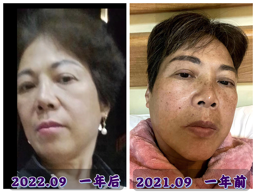 吳美嬌女士用了手擦塑美精油+手擦五行舒美.水四季套裝10個月后的美麗蛻變！